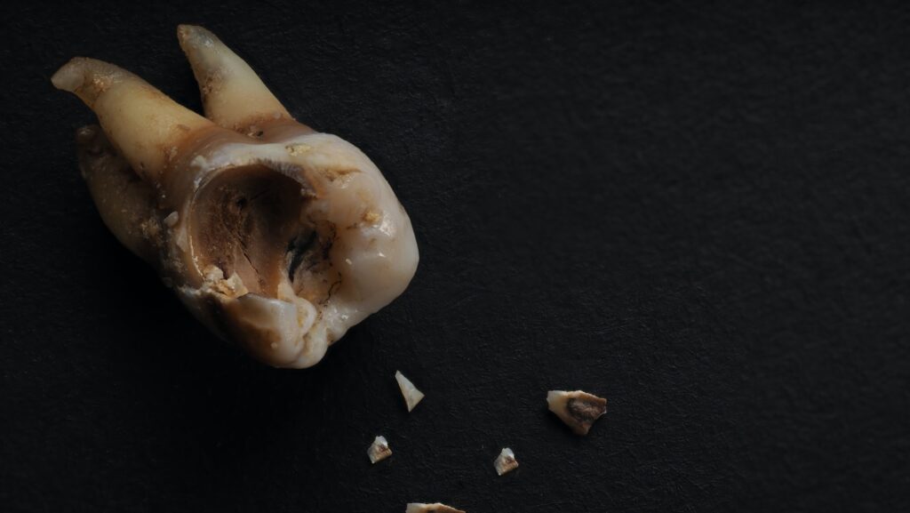 Macro shot of a decayed teeth till root after extraction of dentist.